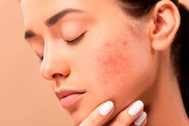 O que a indústria cosmética diz sobre os mitos da acne?