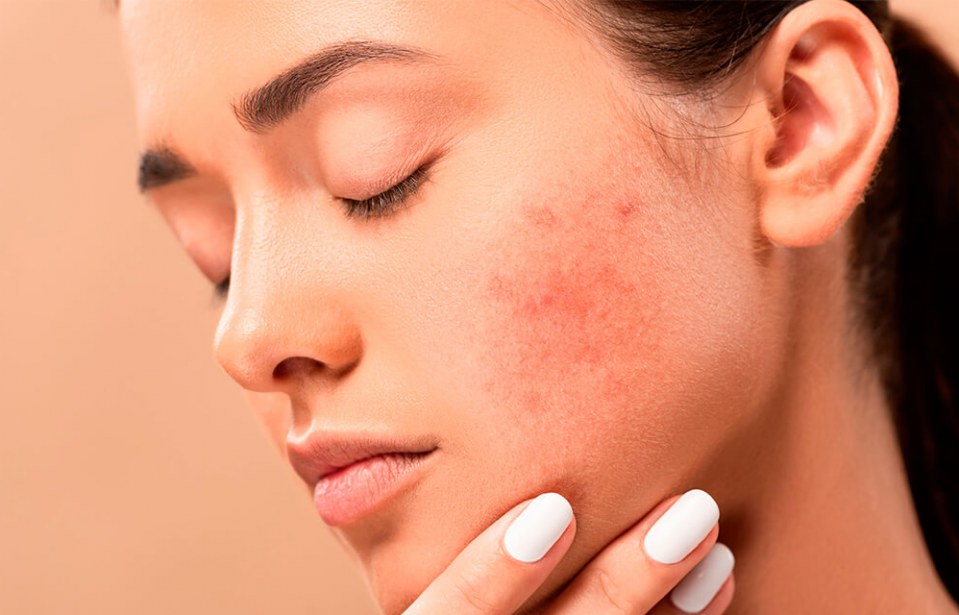 O que a indústria cosmética diz sobre os mitos da acne?