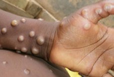 Varíola dos macacos: o que se sabe sobre a mortalidade da doença
